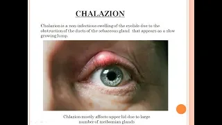 Diseases of Eyelid 1 Chalazion; (ophthalmology by J.D)