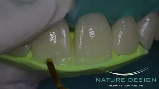 Fechamento de Diastema e Aumentos Incisais