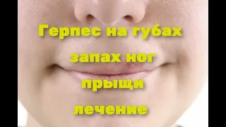 Герпес на губах, прыщей, запах ног, быстрое лечение