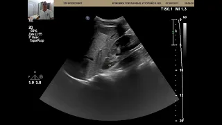 УЗИ органов брюшной полости. 19 лет, девушка, есть новообразование печени.