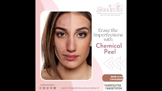 How to Choose the RIGHT Chemical Peel,  Book a free consultation with Skindrella Studio