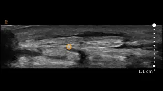 Image Interpretation: Hand Cellulitis