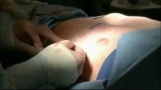 Pectus Excavatum: Modified Nuss Operation