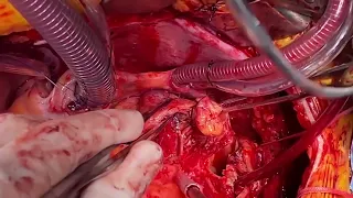 Asvide: Hemiarch Replacement with Aortic Root Preservation for acute Type A Aortic Dissection