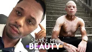 Acne Medication Gave Me Vitiligo & Alopecia | SHAKE MY BEAUTY