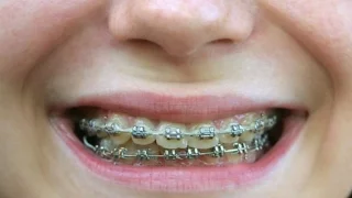 Did Humans ALWAYS Suffer from Crooked Teeth? (The History of Braces)