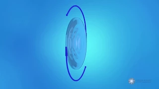 What is a multifocal toric intraocular lens (IOL)?
