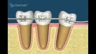 Ортопедическое воздействие на зубы