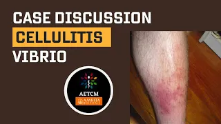 Emergency Medicine Case Discussion || Cellulitis