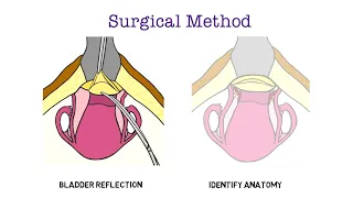 Art of Cerclage Video 7: Abdominal Cerclage