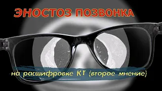 АТЕРОСКЛЕРОЗ АОРТЫ, пневмофиброз легких и ЭНОСТОЗ ПОЗВОНКА на РАСШИФРОВКЕ КТ легких (второе мнение)