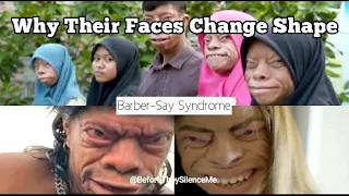 People With Faces That Change Shape | Barber- Say Syndrome