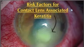 The 3 Risk Factors for Contact Lens Associated Keratitis/ Corneal Ulcer