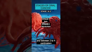 Understanding the Stages of Oral Cancer: Diagnosis and Treatment 🎗️👄 #OralCancer #cancerstages