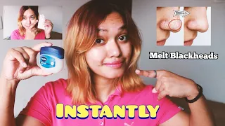 Remove Blackhead INSTANTLY w/ VASELINE + CLING + OIL  | How to get rid of blackheads