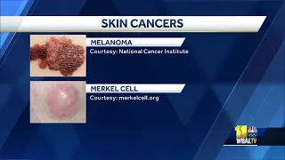 These are the four main types of skin cancer