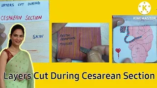 Layers Cut During Cesarean Section # Dr.Anjna Tak