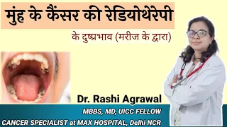 Side effects of radiation treatment in oral cancer patients #Dr Rashi Agrawal Cancer Specialist