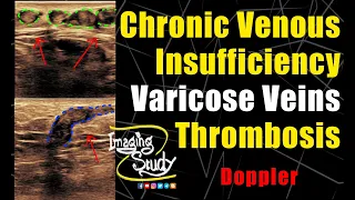 Chronic Venous Insufficiency - Varicose Veins - Thrombosis || Ultrasound || Doppler || Case 252