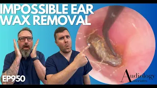 IMPOSSIBLE EAR WAX REMOVAL - EP950
