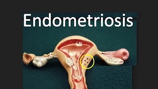 Endometriosis