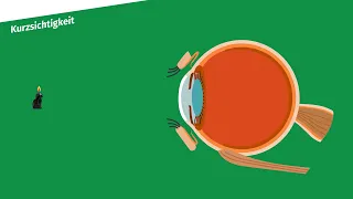 Sehfehler – verschiedene Sehschwächen und Korrekturmöglichkeiten einfach erklärt | sofatutor