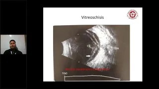 "A quick guide to Ophthalmic Ultrasound/ B-Scan interpretation" by  MR AMIT KUMAR SINGH