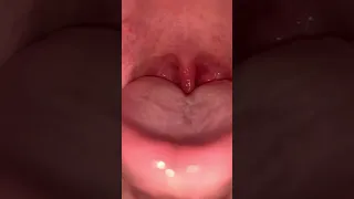 Potentially gross: Elongated Uvula