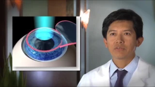 The LASIK Procedure at SIghtMD