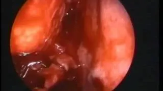 Endoscopic Orbital Decompression Under Local Anesthesia