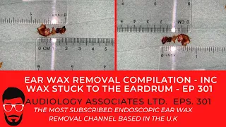 EAR WAX REMOVAL COMPILATION - INC WAX STUCK TO THE EARDRUM - EP 301