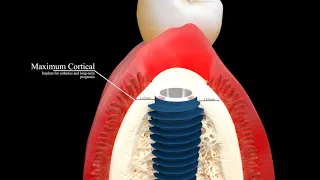 AnyRidge  - The Biologically Driven Implant System