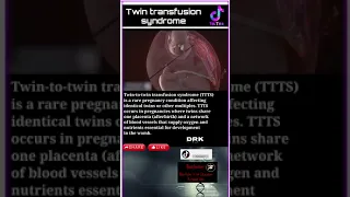 twin transfusion syndrome