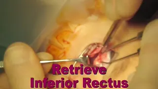 Inferior Oblique Myectomy