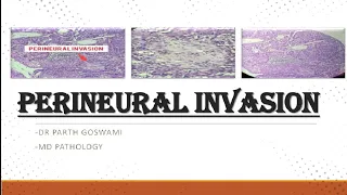 Perineural Invasion SCC || Simplified explanation || Images