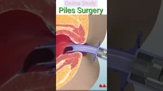 Piles Surgery 👨‍⚕️