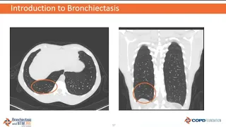 Bronchiectasis Q & A webinar with Dr. Tim Aksamit