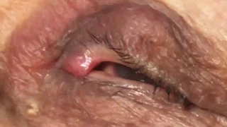 Dacryolith 03 - Removing infected stones from the eyelid