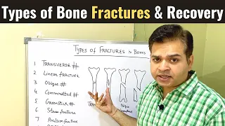 Types of Bone Fractures, Open and Closed Fracture- Everything you need to know, Fracture Healing