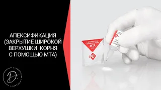 Апексификация - закрытие широкой верхушки корня с помощью МТА