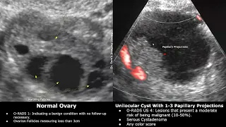 Ovarian-Adnexal Reporting and Data System Ultrasound (O-RADS US) | Classification Of Ovarian Lesions