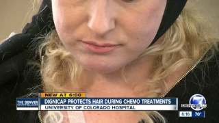 UCHealth using new device to reduce hair loss in chemotherapy patients