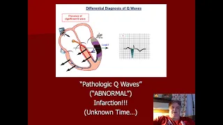 12-Lead EKG Q Waves - Differential Diagnosis