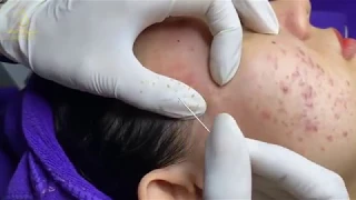 Love hasn't come to me because blackheads are too much in me (customer says) # 167 | Loan nguyen