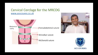 Cervical cerclage for the MRCOG: RCOG Guideline. Preterm Birth. McDonald or Shirodkar suture.