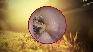 Satisfying Ear Wax Removal With Dr Zhao Video P237