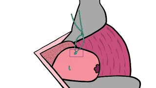 Art of Cerclage Video 8: Vaginal Cerclage Removal