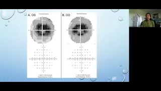 Lecture: Ocular Complications of Medications