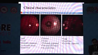 AIOC2019 FP 1262 Vitreo Retinal Diseases   IV Macular coloboma  Comparison Dr Devesh Kumawat