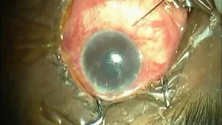 AC Tap and Intravitreal antibiotic injection in Endophthalmitis
